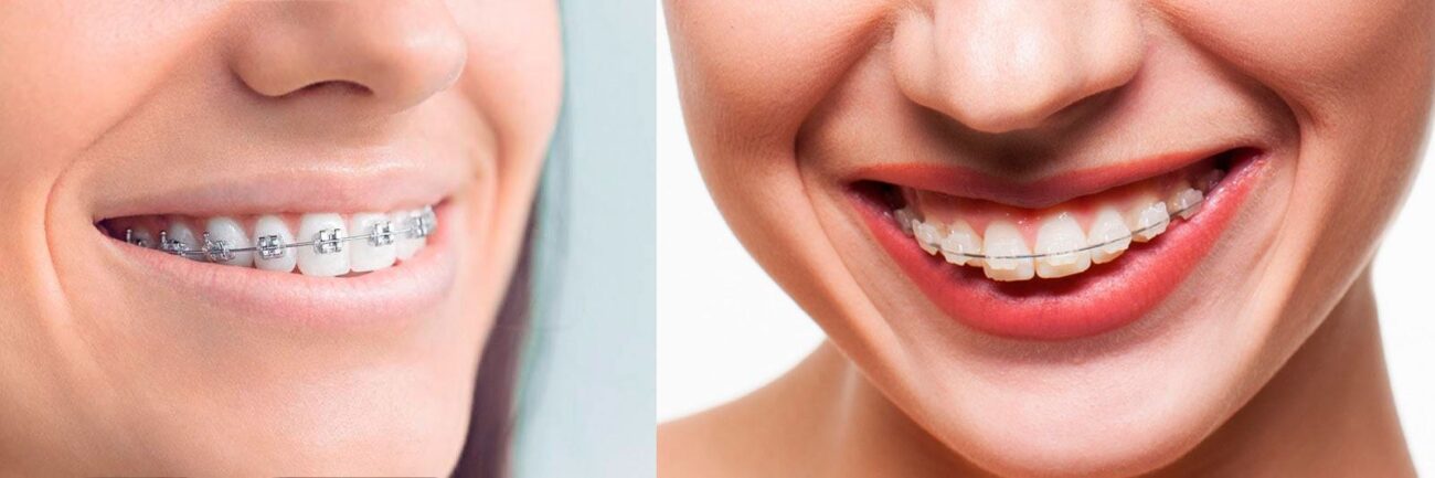 how much do braces cost​