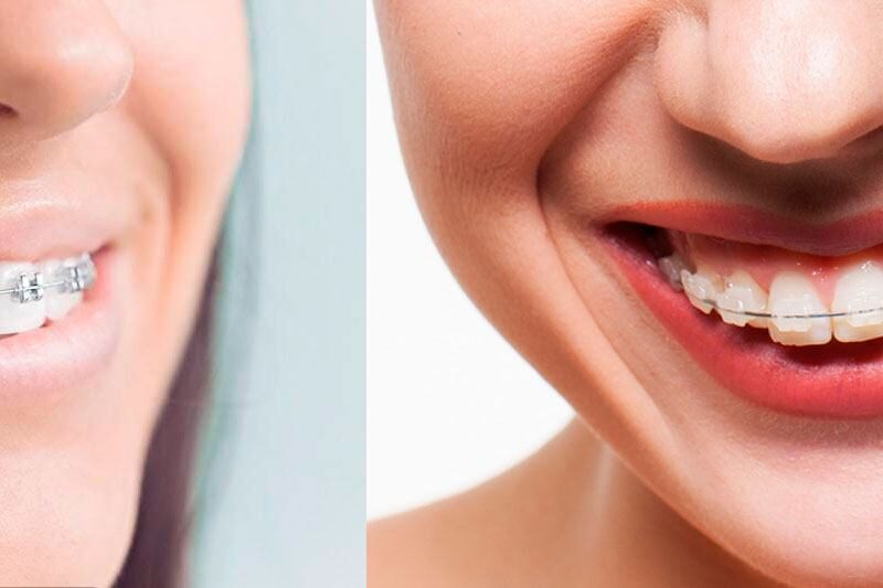 how much do braces cost​